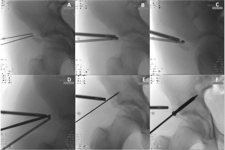 Six fluoroscopic panels, A to F, showing instruments at an AIIS avulsion fragment, a guidewire across it and a screw passed over the guidewire