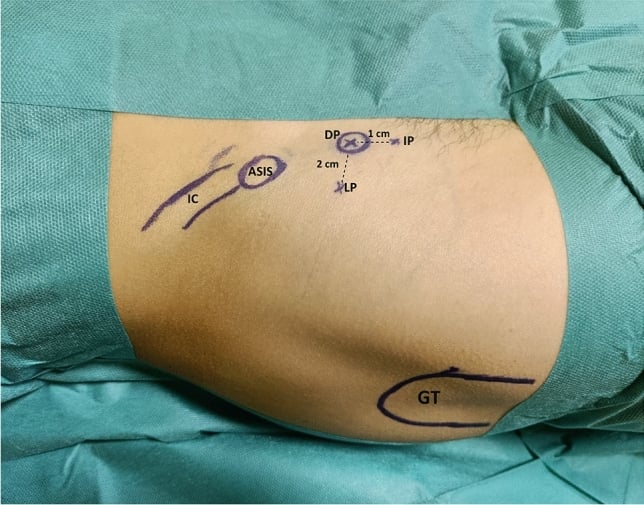 Draped hip with the iliac crest, ASIS and greater trochanter drawn on the skin, and direct, inferior and lateral AIIS portals marked 1 cm and 2 cm apart