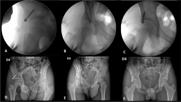 Three final fluoroscopic views and three AP pelvic radiographs marked DX, each showing a single screw in the right AIIS