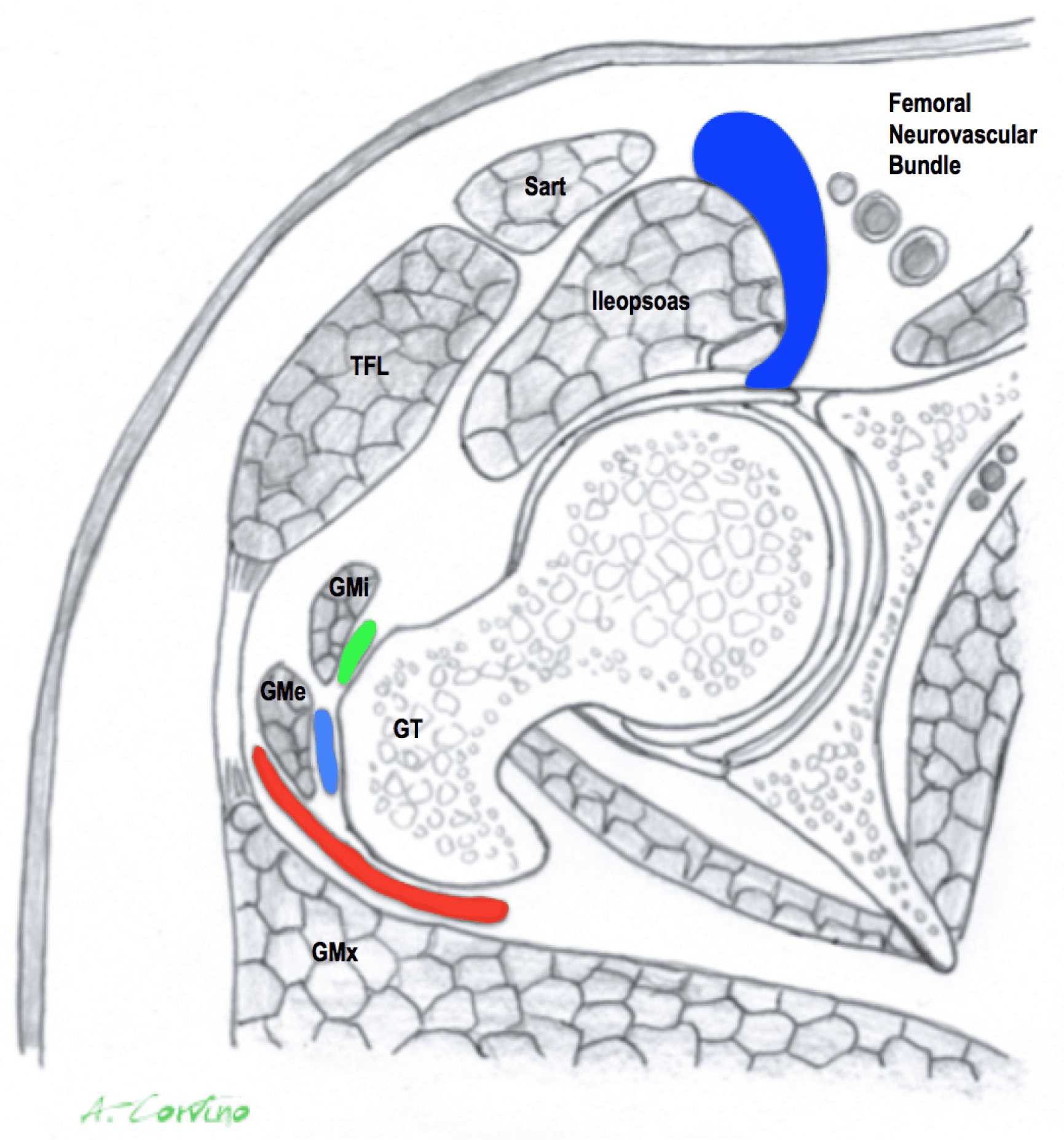 Transverse hip schematic with the iliopsoas bursa in dark blue along the deep and medial side of the iliopsoas, reaching the anterior capsule, lateral to the femoral neurovascular bundle