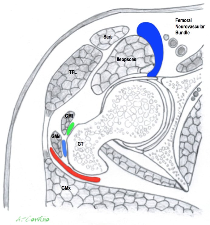 Coronal and axial T2 MRI of normal iliopsoas tendon insertion at the lesser trochanter
