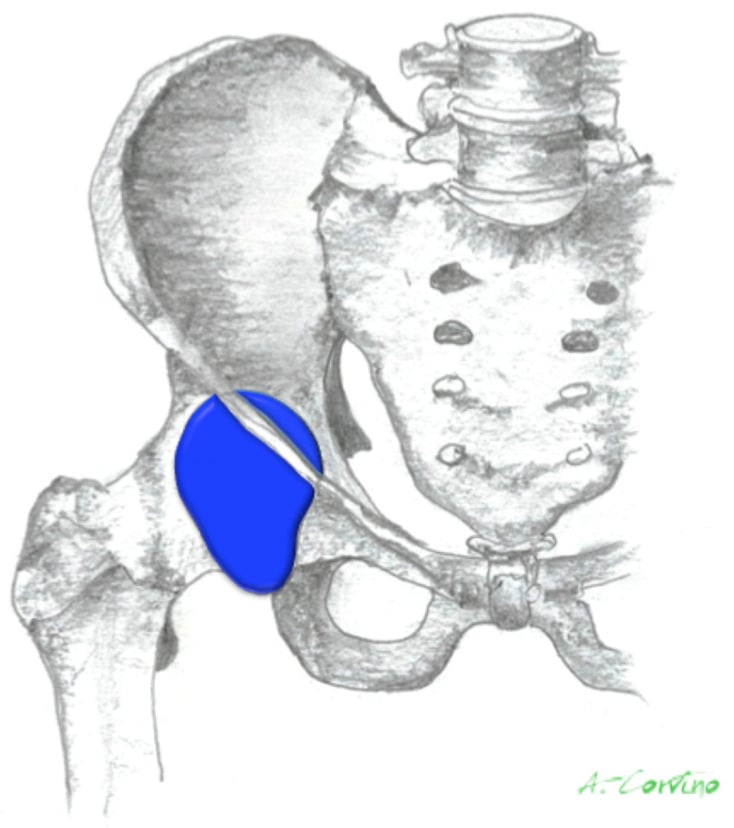 Axial T2 FS MRI demonstrating acute iliopsoas bursitis and muscle edema