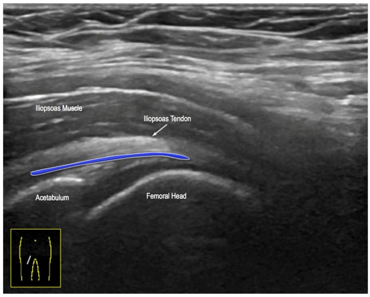 Ultrasound scans of iliopsoas tendon sheath thickening and bursa distension