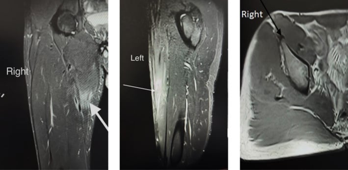 Coronal and axial STIR MRI of acute rectus femoris proximal origin avulsion strain