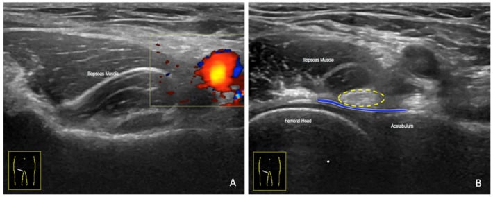 Coronal and axial MRI of iliopsoas tendon impingement following total hip arthroplasty