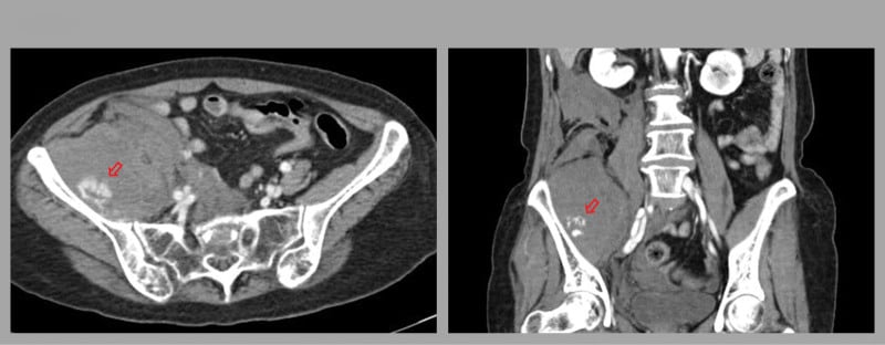 Axial and coronal contrast CT with red arrows marking contrast blush within a large right iliacus haematoma