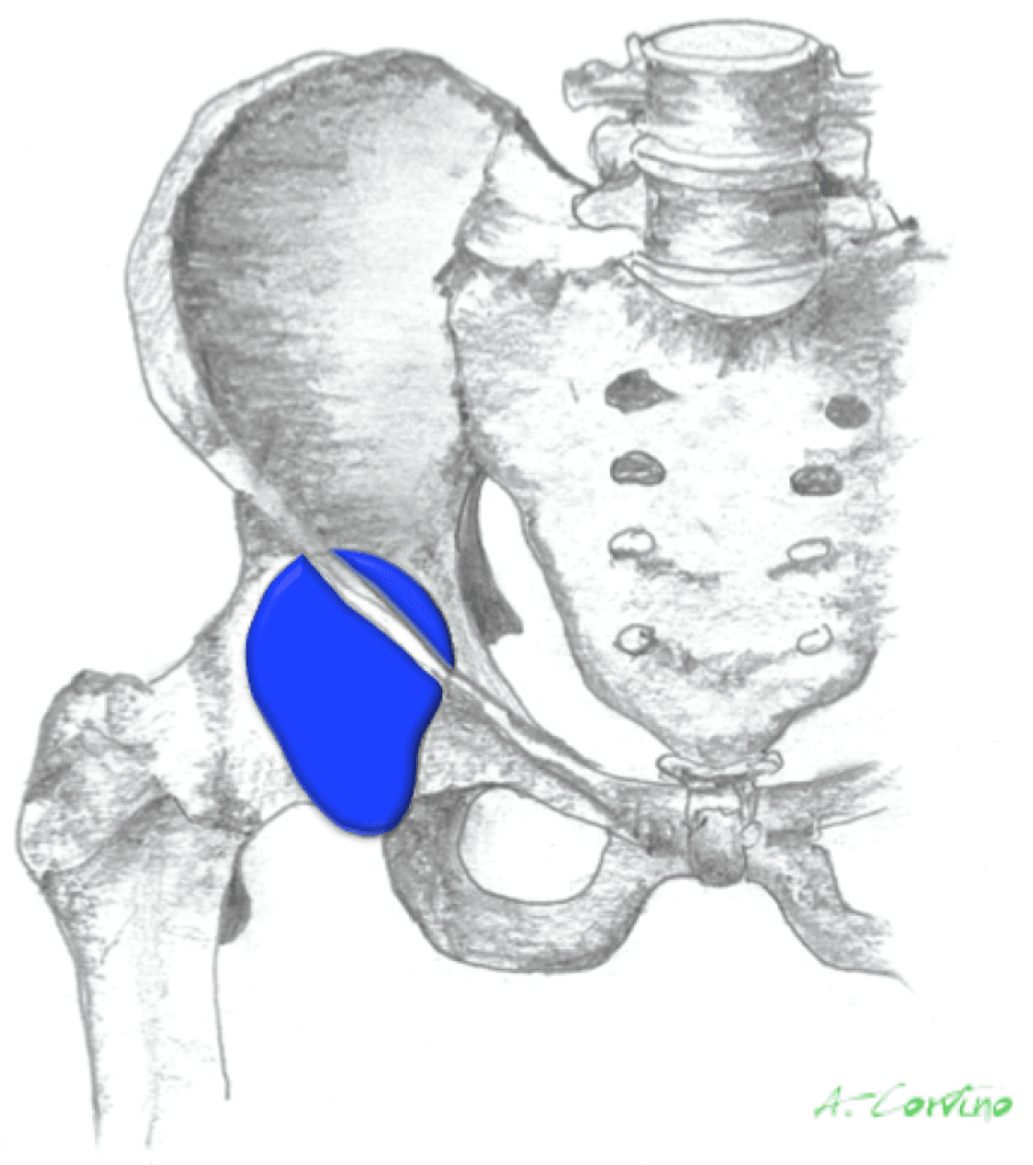Anterior view of the pelvis and proximal femur with the iliopsoas bursa shaded blue over the front of the hip joint