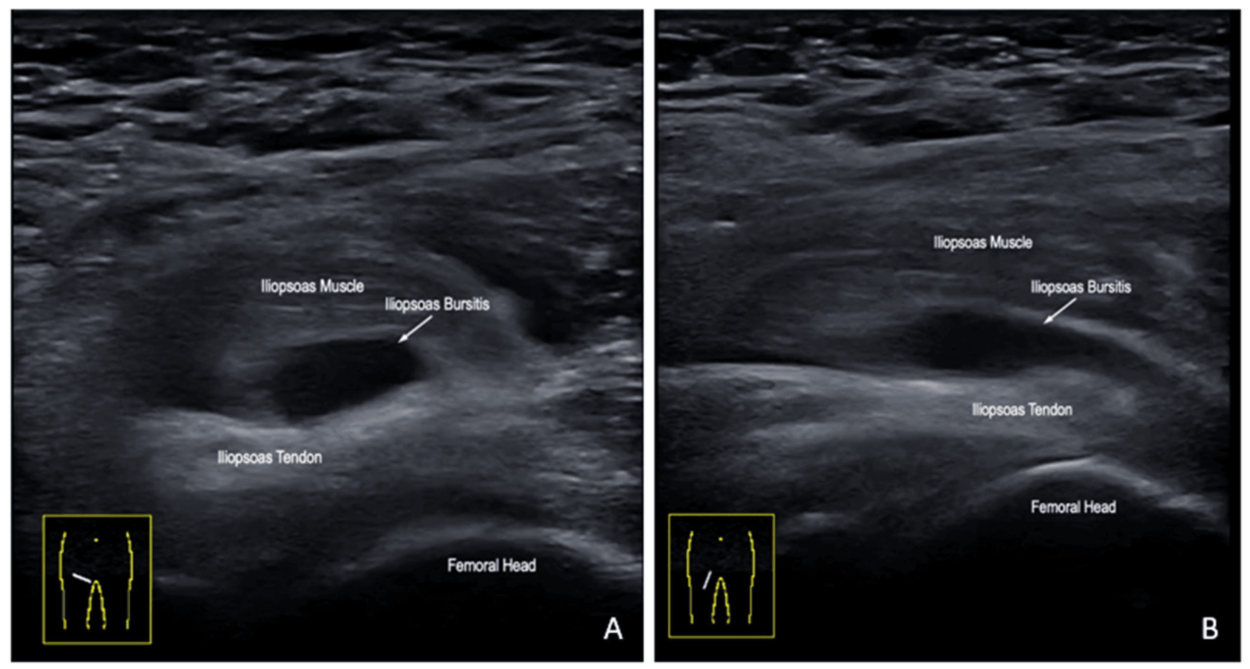 Two ultrasound panels of iliopsoas bursitis, with an arrow at an anechoic collection between the labelled iliopsoas muscle and iliopsoas tendon above the femoral head
