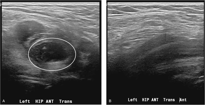 Transverse ultrasound of the left anterior hip, A with a circled iliopsoas haematoma and B after ultrasound-guided aspiration