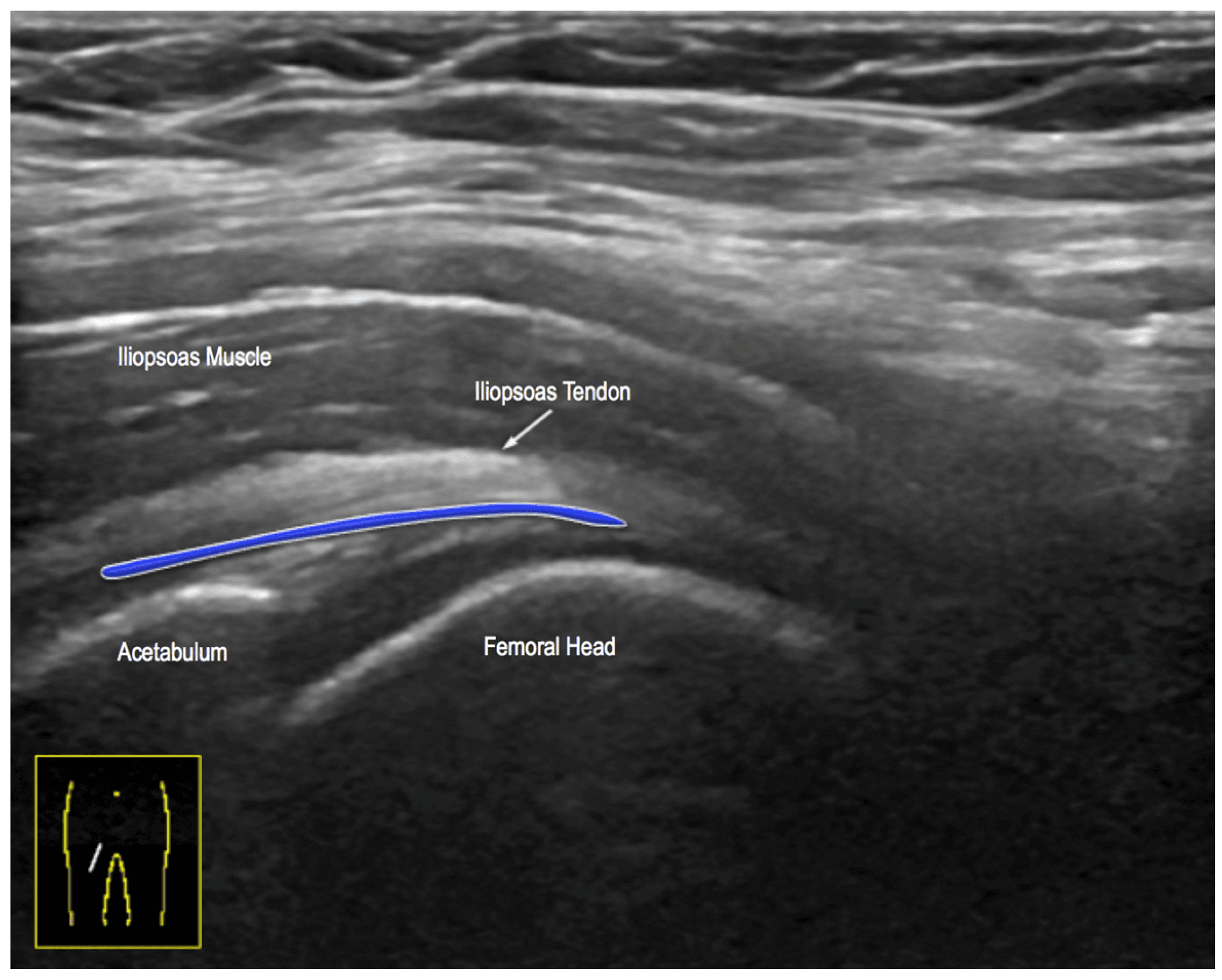 Longitudinal oblique ultrasound with the iliopsoas muscle and tendon labelled over the acetabulum and femoral head, and a blue line beneath the tendon