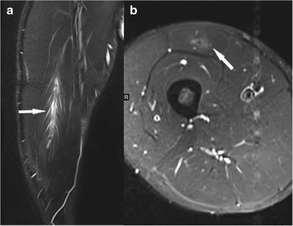 Two MRI panels, a long-axis view and an axial view of the thigh, with arrows marking feathery high signal in the rectus femoris