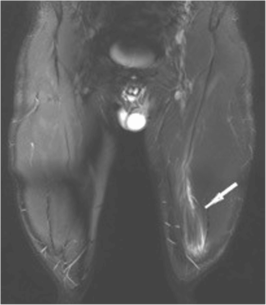 Coronal MRI of both thighs with an arrow marking high signal in the distal part of the left rectus femoris