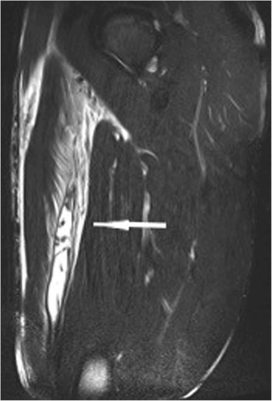 Long-axis MRI of the thigh showing a long subtotal rectus femoris tear with a high-signal haematoma along the anterior thigh