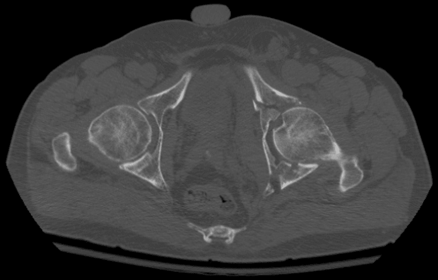 Axial CT scan showing an acetabular fracture pattern at the level of the femoral heads