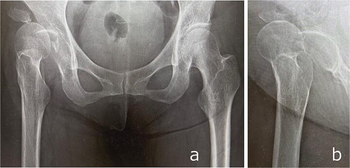 Anteroposterior and lateral radiographs showing an anterior hip fracture-dislocation
