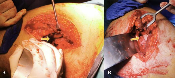 Operative views of a femoral head buttonholed through a capsular tear
