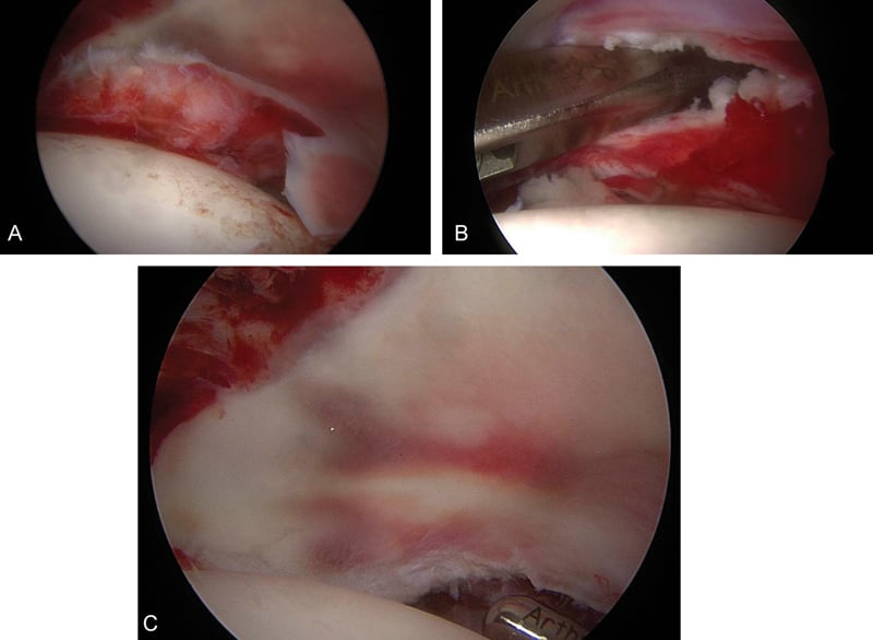 Arthroscopic sequence showing an enfolded labrum being reduced with a hook