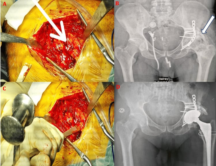 Radiograph and operative sequence showing mature heterotopic ossification bridging the greater trochanter and acetabulum