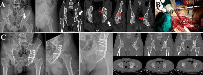 Radiograph CT operative and postoperative sequence showing distractor-assisted retrieval of an incarcerated posterior-wall fragment