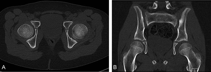 Axial and coronal CT showing a bony fragment preventing concentric hip reduction