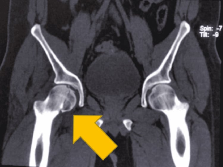 Coronal CT of the pelvis with an arrow marking a Pipkin II femoral-head fracture