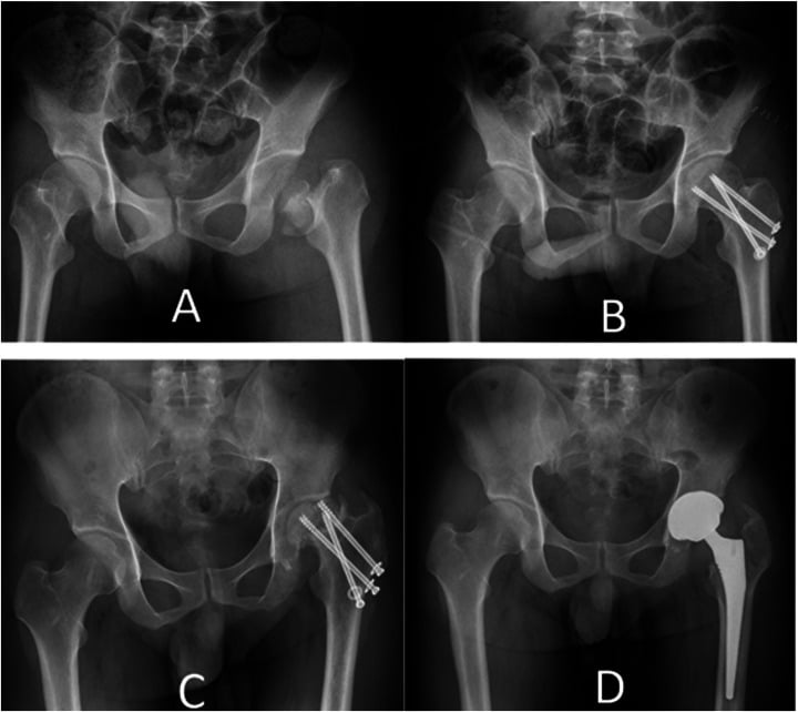 Serial radiographs of a Pipkin III injury showing fixation failure femoral-head necrosis and conversion to arthroplasty