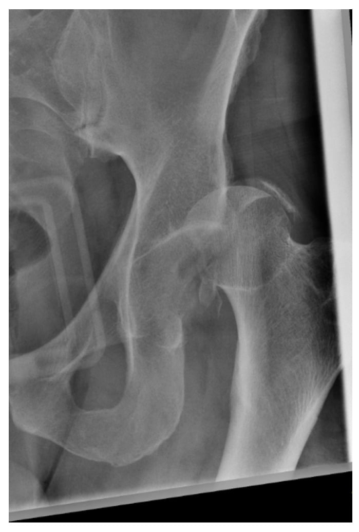 Pelvic radiograph showing hip dislocation with a Pipkin classification Type IV femoral-head and acetabular fracture