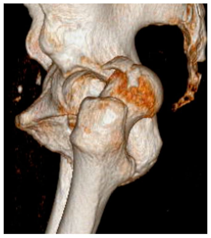 Three-dimensional CT reconstruction of a Pipkin classification Type IV femoral-head fracture-dislocation