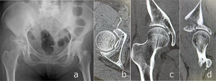 Post-reduction radiograph and CT showing an intra-articular femoral-head fragment