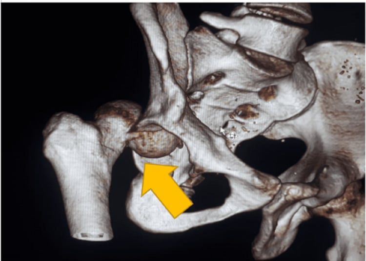 Three-dimensional CT showing posterior hip dislocation with a Pipkin II femoral-head fragment