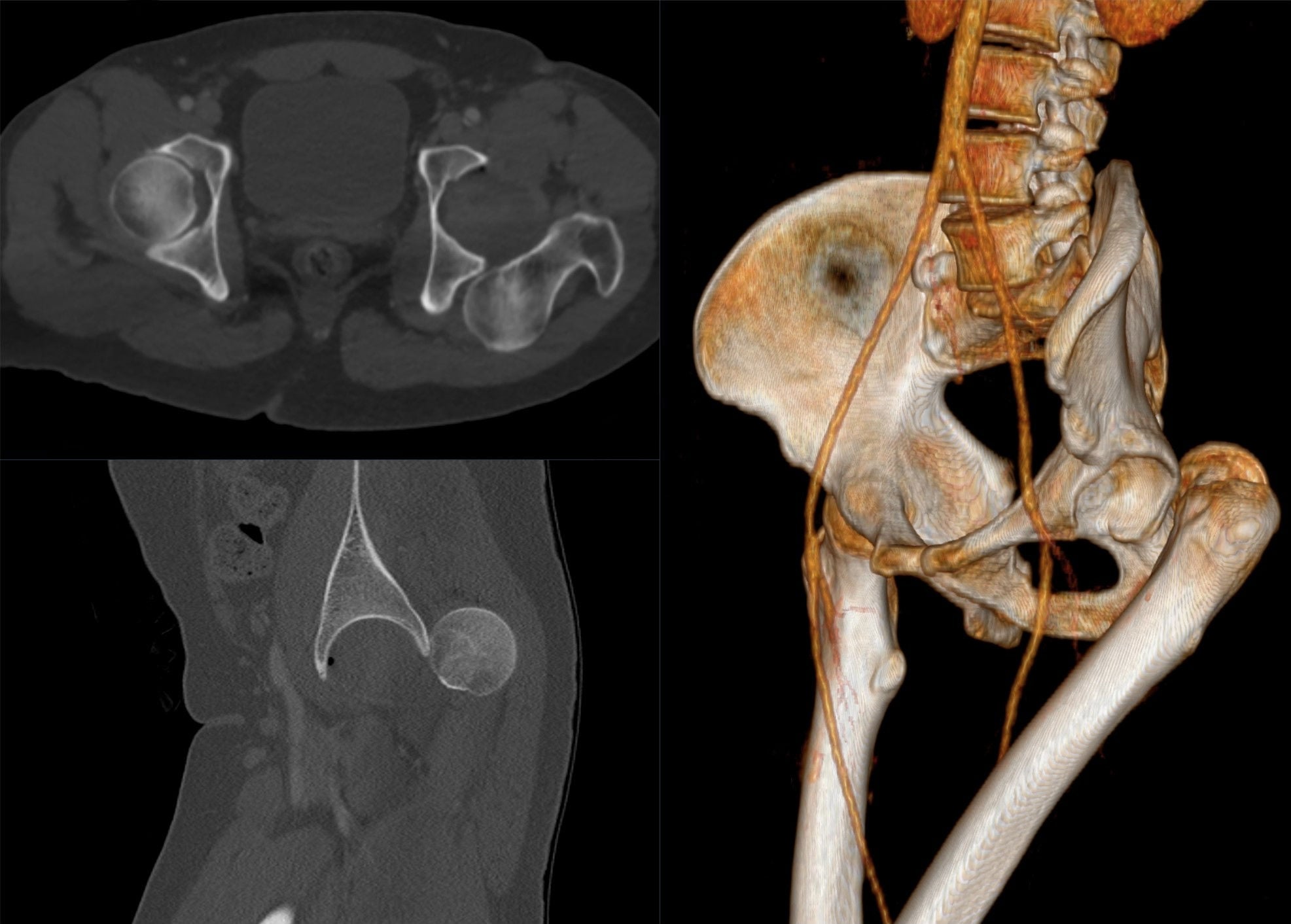 CT 3D reconstruction of traumatic posterior hip dislocation showing femoral head displaced posteriorly