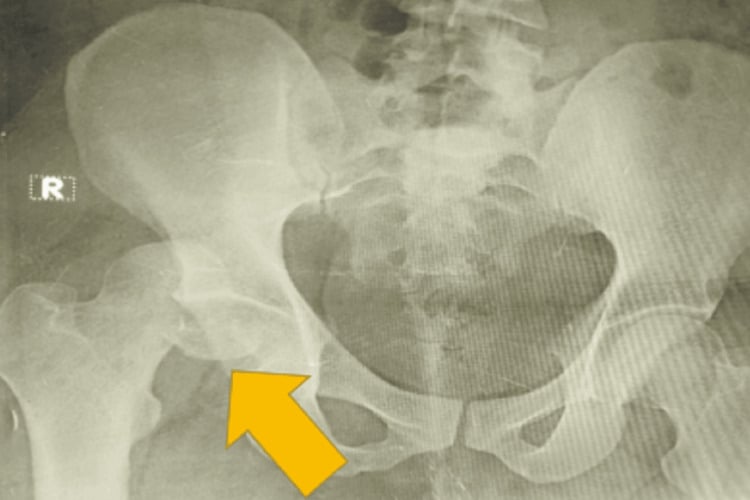 Hip radiograph showing posterior dislocation with a displaced femoral-head fracture