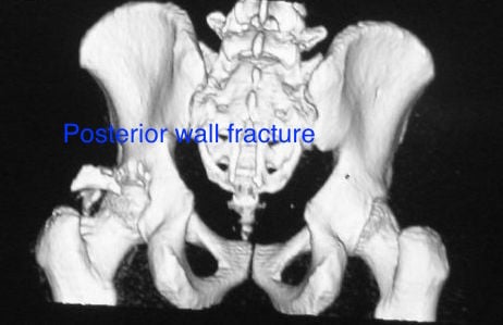 3D CT scan showing posterior wall acetabular fracture with fragment displacement