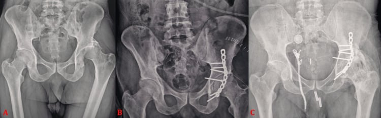 Serial pelvic radiographs showing posterior-wall fracture-dislocation fixation and later post-traumatic arthritis