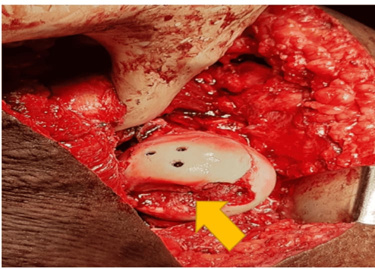 Operative view of a femoral-head fracture reduced through surgical hip dislocation and fixed with headless screws