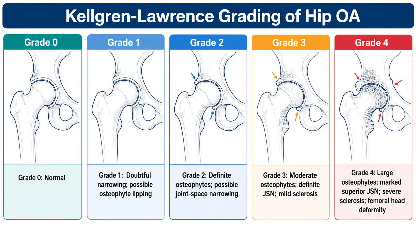 Kellgren-Lawrence grading of hip OA