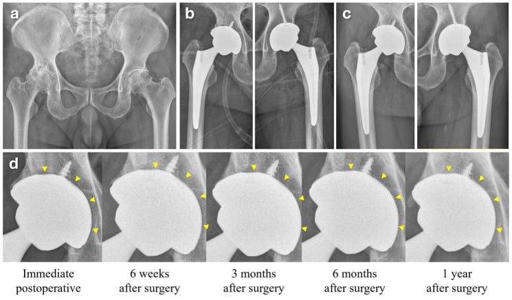Serial anteroposterior hip radiographs before and after cementless total hip arthroplasty with progressive acetabular osseointegration
