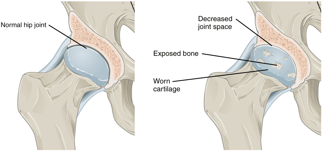 Comparison of a normal hip joint and an osteoarthritic hip joint