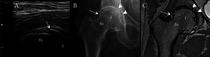 Femoral neck osteophyte shown on ultrasound, anteroposterior radiograph and coronal proton-density MRI