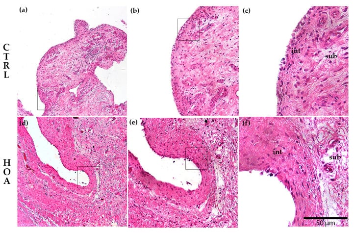 Histological comparison of control and hip osteoarthritis synovium at progressively higher magnification