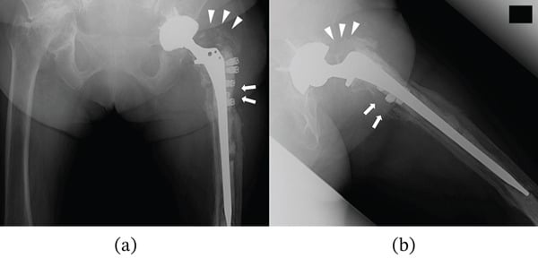 Anteroposterior and lateral hip radiographs showing extensive proximal femoral osteolysis around infected total hip arthroplasty fixation
