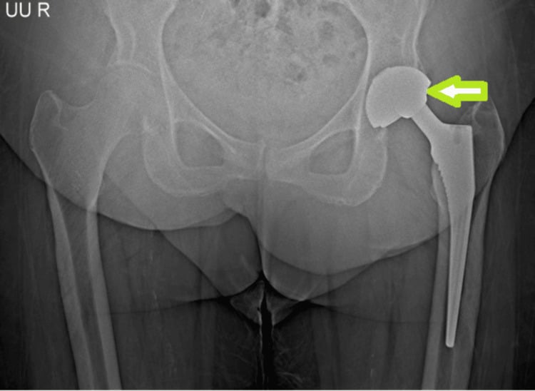 Anteroposterior pelvis radiograph showing eccentric femoral head position within a total hip arthroplasty acetabular shell