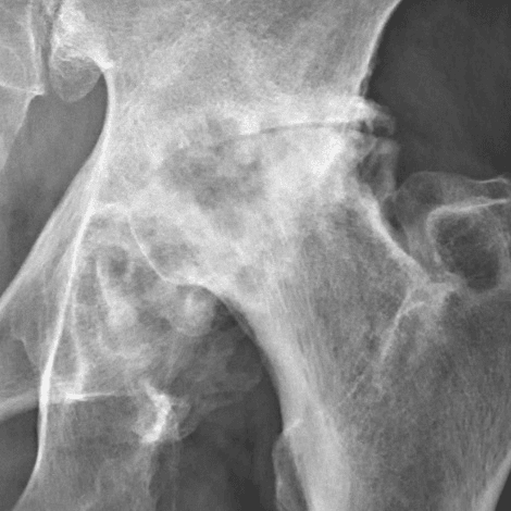 AP radiograph of severe (Tönnis grade 3) hip osteoarthritis