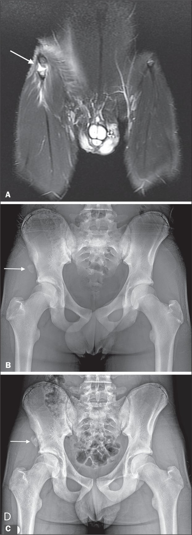 MRI and serial pelvic radiographs showing adolescent AIIS avulsion