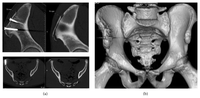 Preoperative and postoperative CT showing screw fixation of iliac crest avulsion