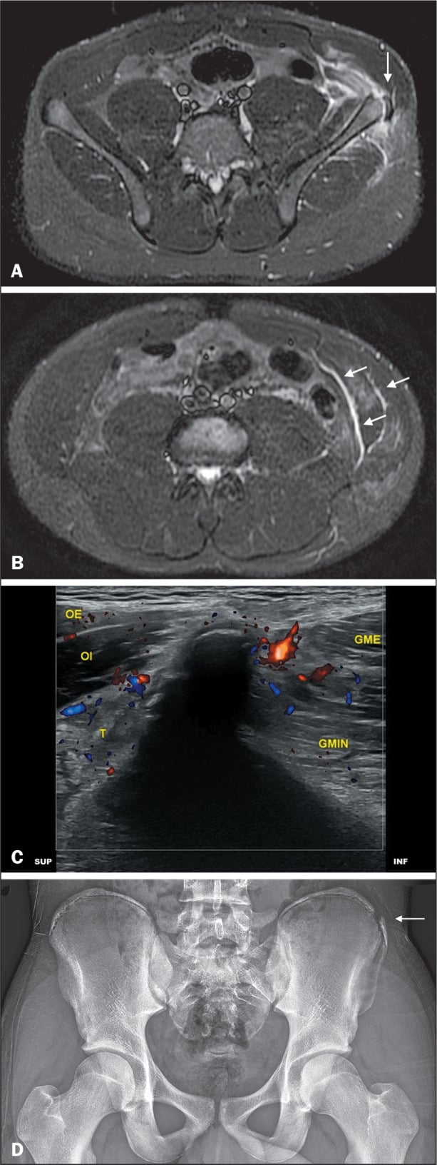 Multimodal MRI ultrasound and radiograph of iliac crest apophyseal avulsion