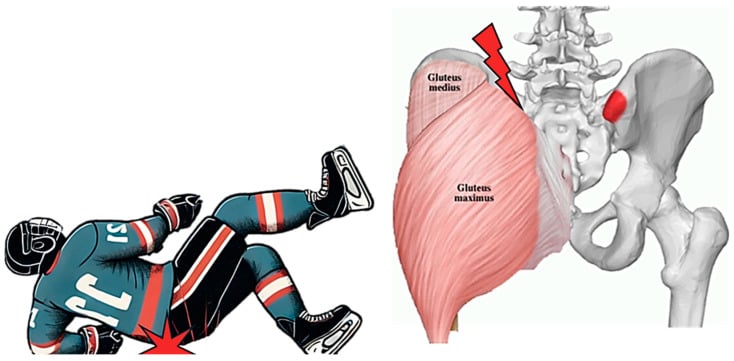 Illustration of a backward fall and posterior hip pointer at the iliac crest