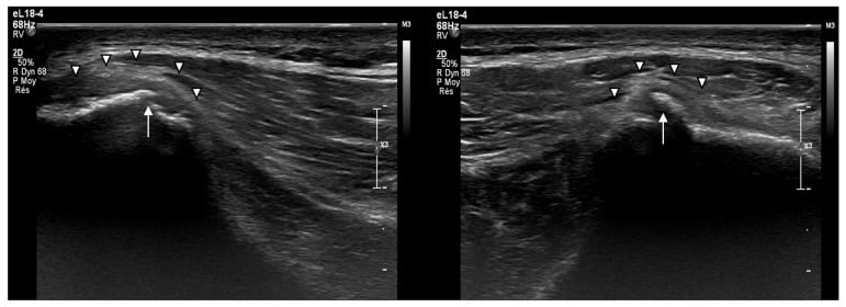 Follow-up ultrasound of the posterior iliac crest showing periosteal thickening and calcification