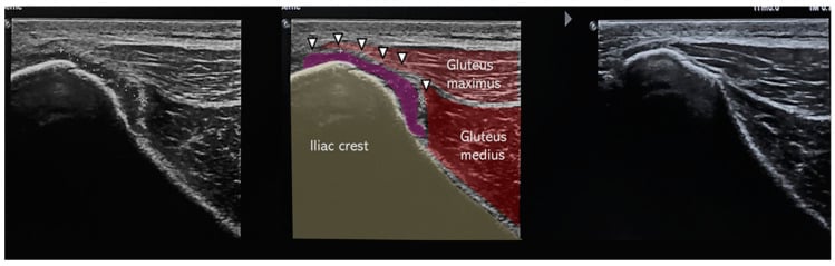 Comparative ultrasound showing posterior iliac crest periosteal detachment