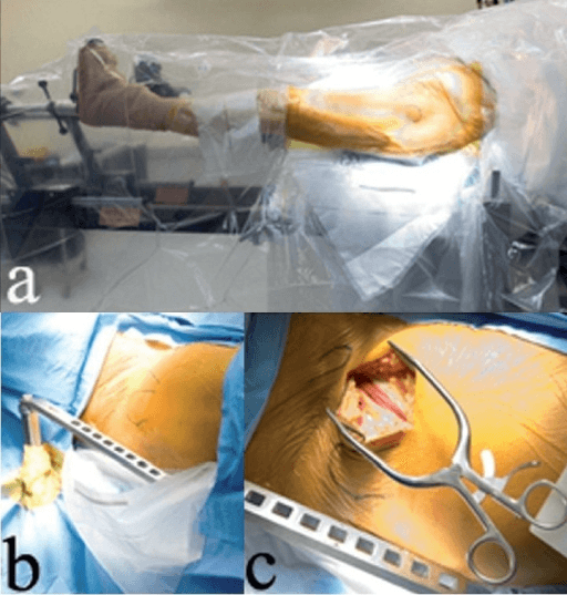 Minimally invasive THA surgical setup and exposure